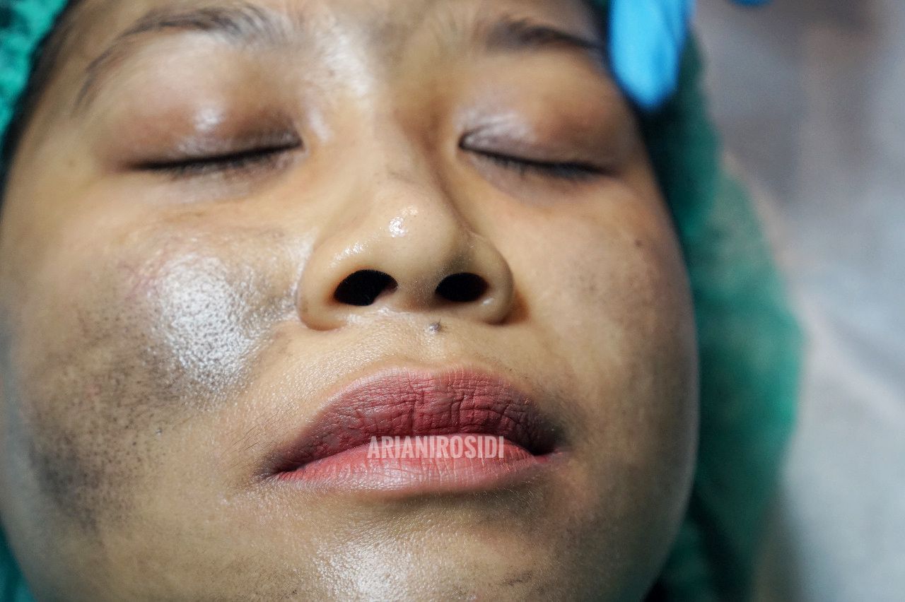 treatment erha treatment erha